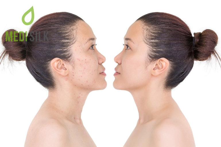 Acne Scars - Before & After