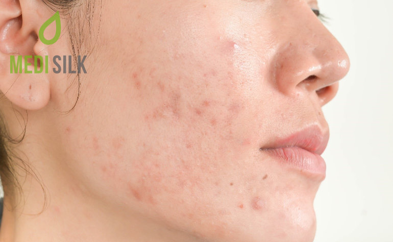 Atrophic acne scars